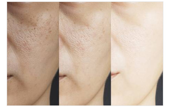how to get rid of hyperpigmentation