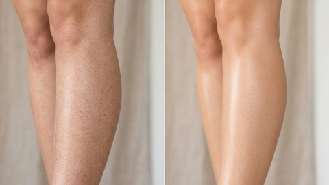 8 Natural Ways to Get Rid of Strawberry Legs