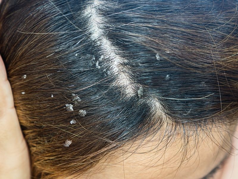 dandruff in woman's hair