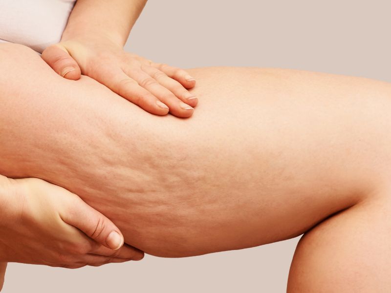 Woman showing cellulite on skin