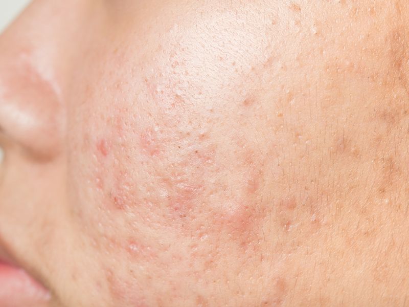 5 common skin diseases and disorders