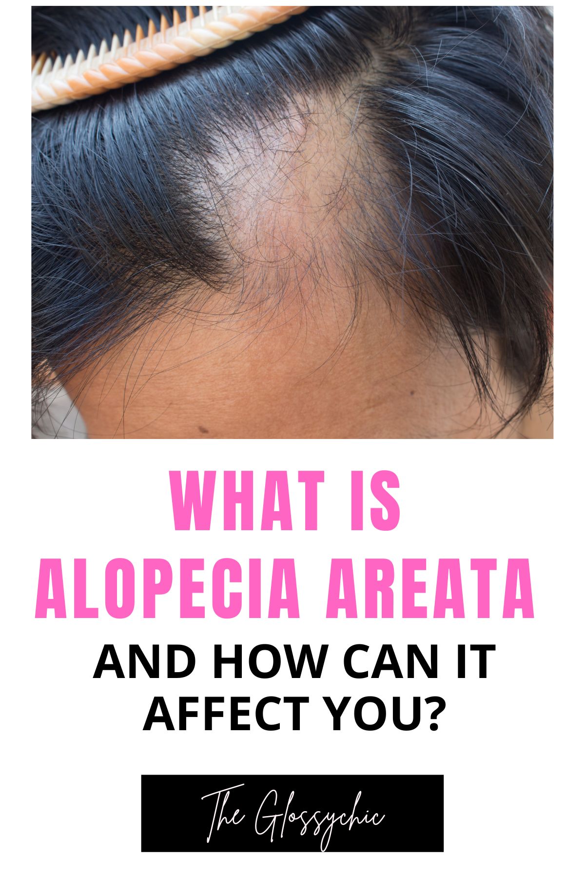 What Is Alopecia Areata And How Can It Affect You?
