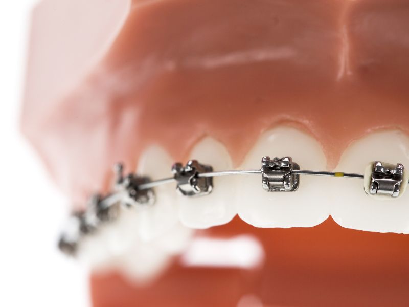 How Adult Orthodontics Can Help Prevent Dental Problems and Improve Your Overall Health
