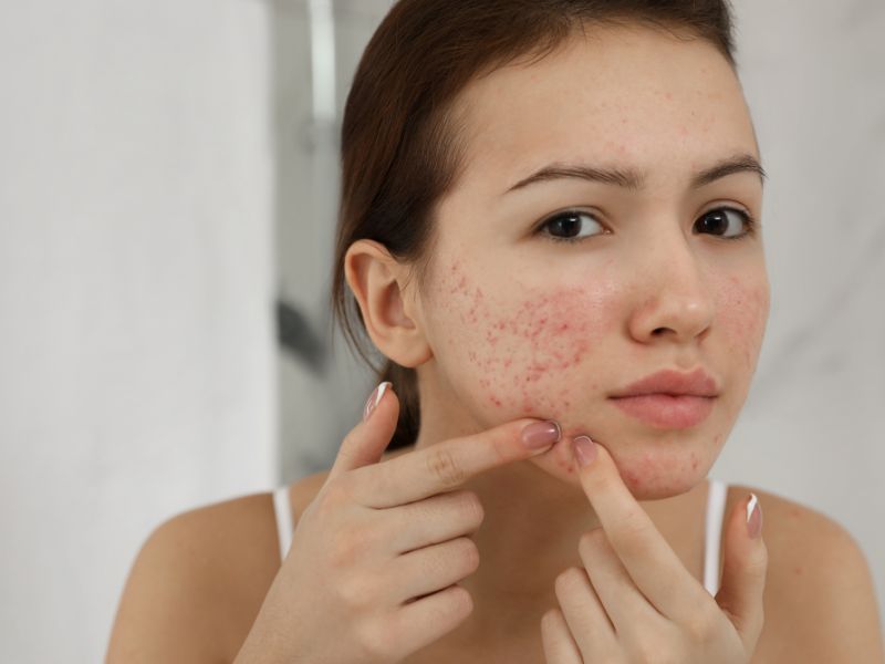 Home Remedies For Pimples: Natural Solutions For Clear, Healthy Skin
