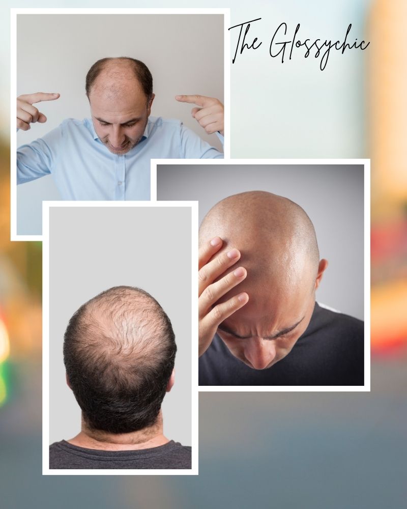 bald Dealing With Baldness: 4 Tips